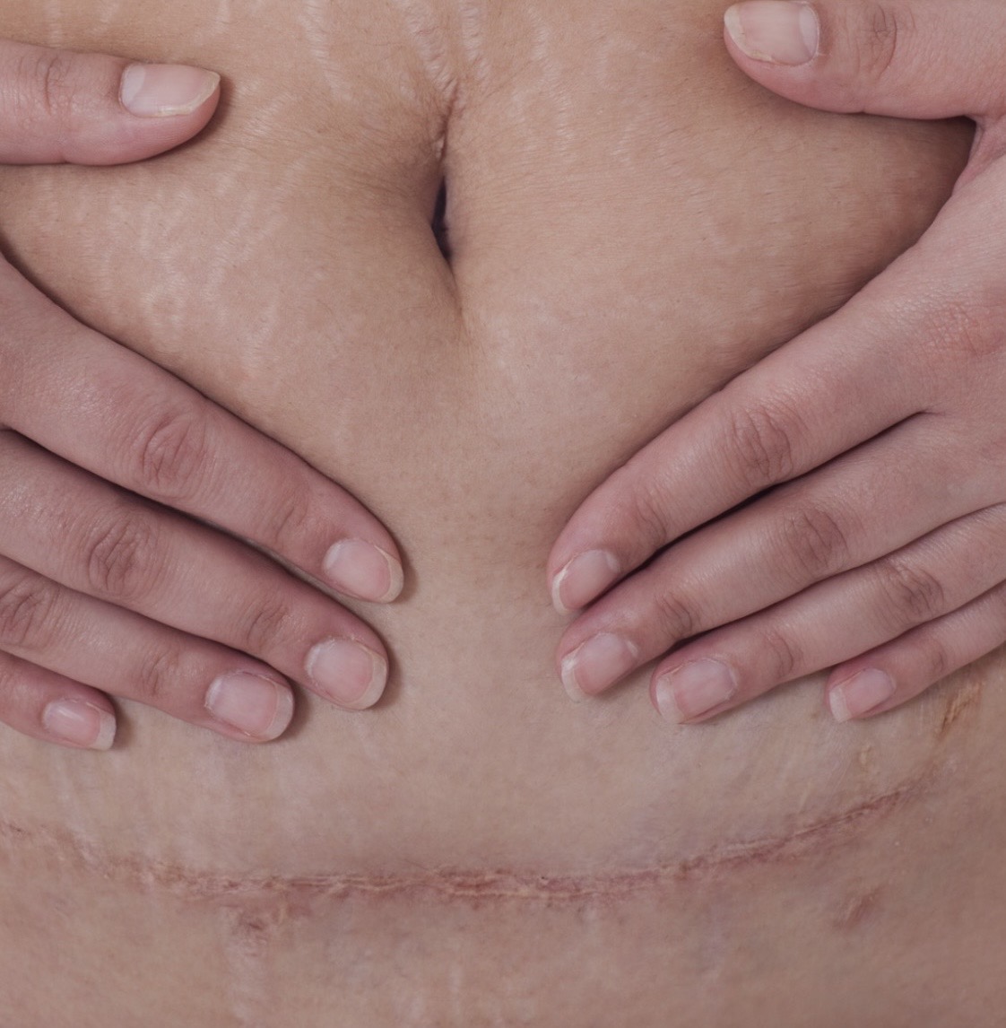 pic of c section 