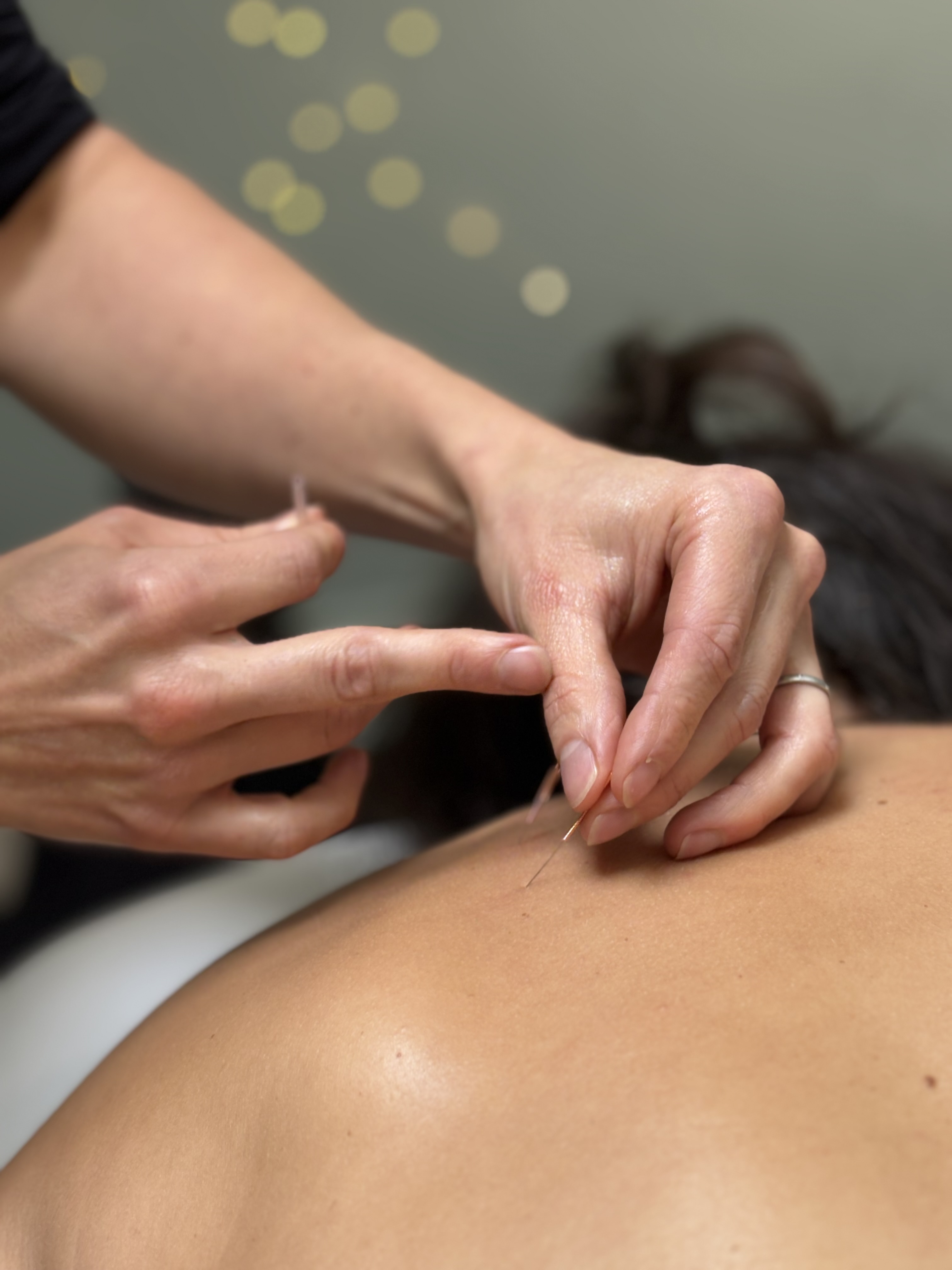 pic of dry needling 