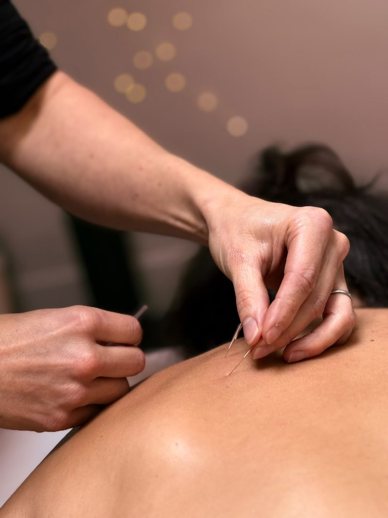 Dry needling treatment on a client's upper back